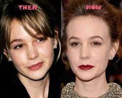 Carey Mulligan before surgery